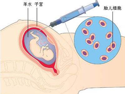 羊水亲子鉴定